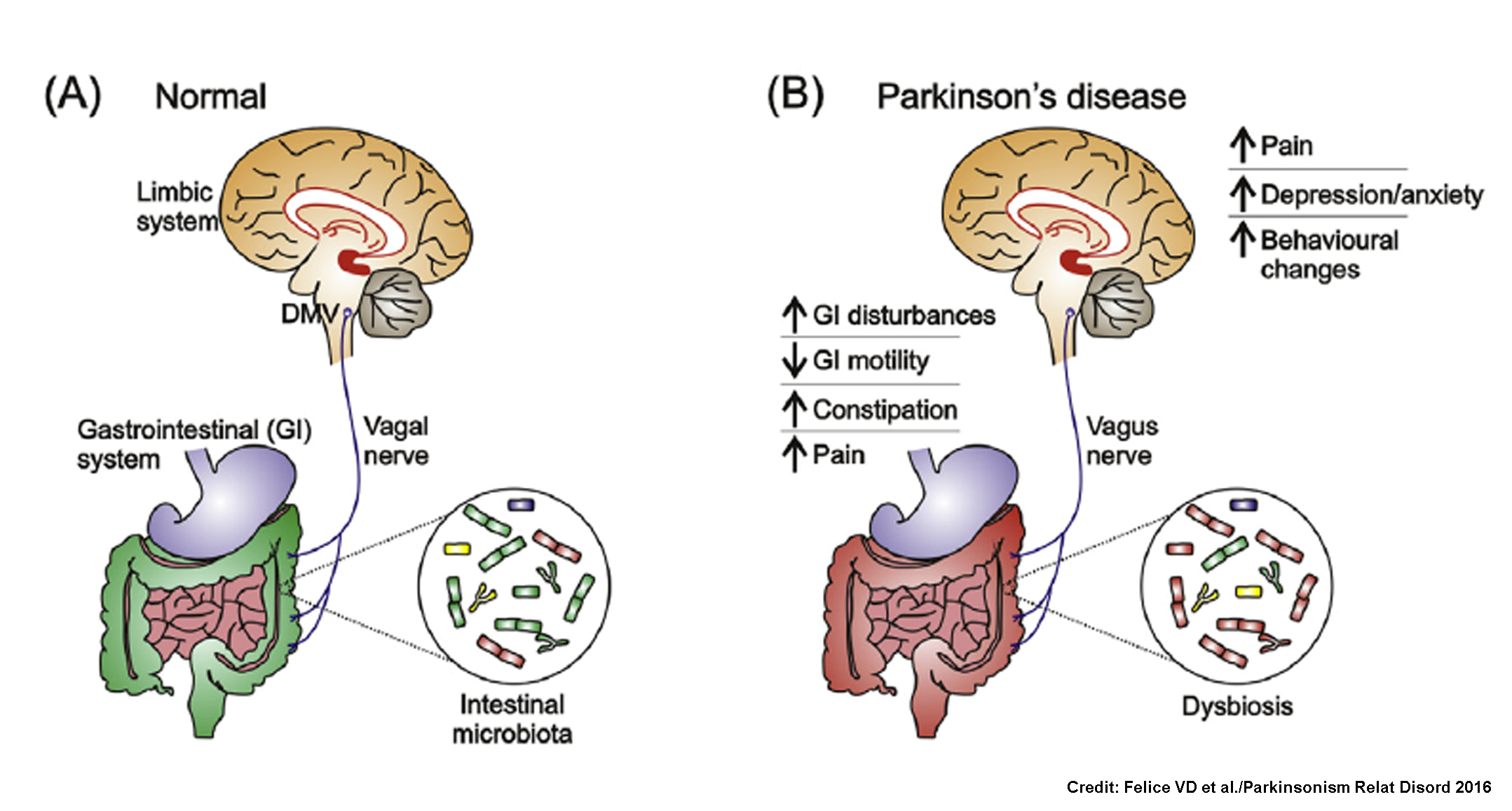 Parkinson's disease gut research