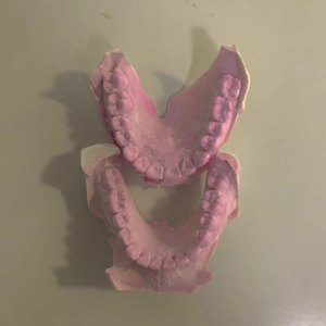 正畸的尽头是自制保持器